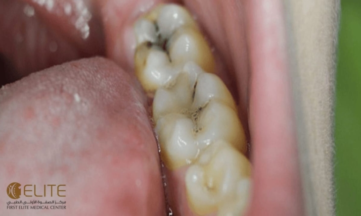 العدو الخفي لابتسامتك: تأثير السكريات على الأسنان